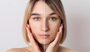 پوست بهترین مارک کرم ضد جوش؛ انتخابی برای پوستی سالم