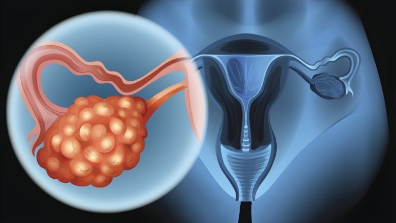 مولکول F2R؛ امیدی نوین در تشخیص زودهنگام و درمان هدفمند سرطان تخمدان